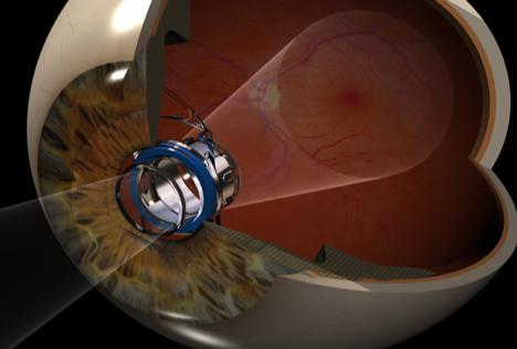 implantable telescope