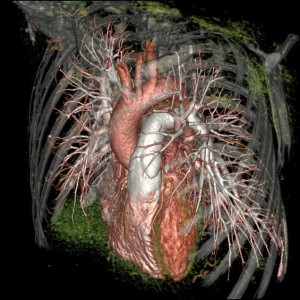 The image from the GE Healthcare Revolution CT scanner shows the patients coronary arteries, aorta, pulmonary arteries, and adjacent intrathoracic structures.