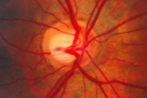 Optic nerve head of patient with glaucoma.