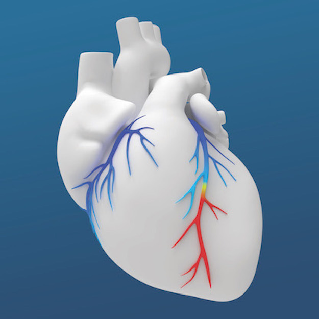 The HeartFlow FFR Analysis is a non-invasive tool that helps Scripps cardiologists identify possible areas of coronary artery blockage. (Courtesy of Scripps Health)