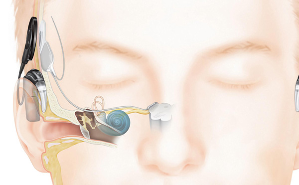 An auditory brainstem implant has two parts: a sound processor, worn behind the ear, and an implant that connects below the skin. (Photo courtesy of Cochlear Americas)