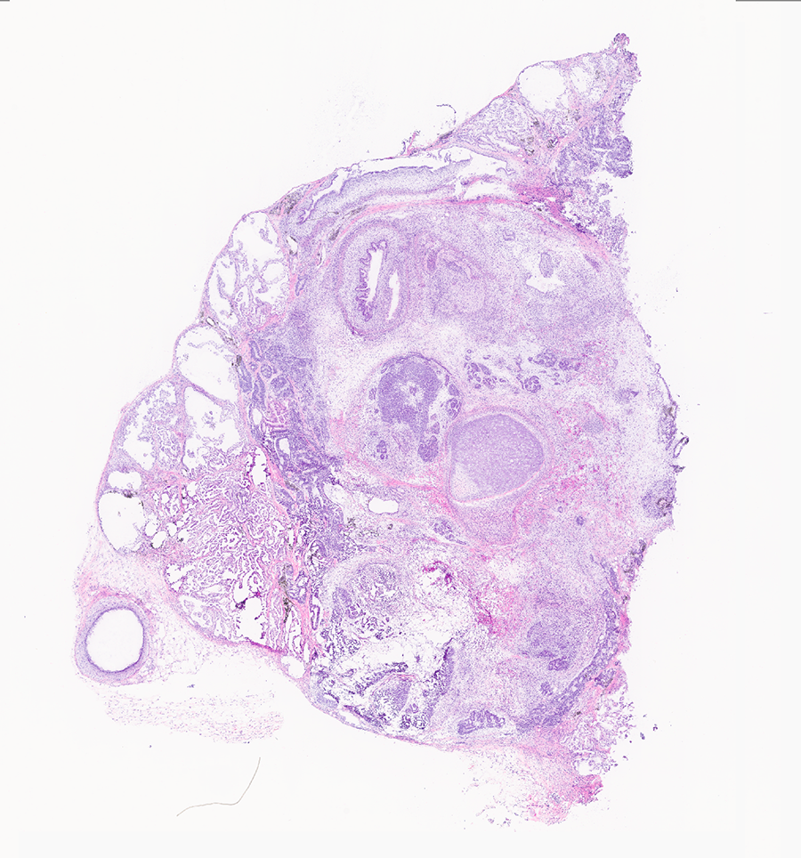 Histology image of a teratoma